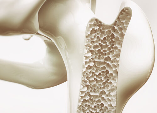 Photo of osteoporosis damage to human bones