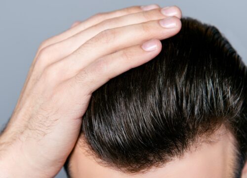 Photo of a man's hairline with some hair loss